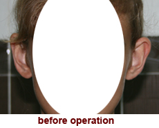 plastic-surgery-prominent-ear 